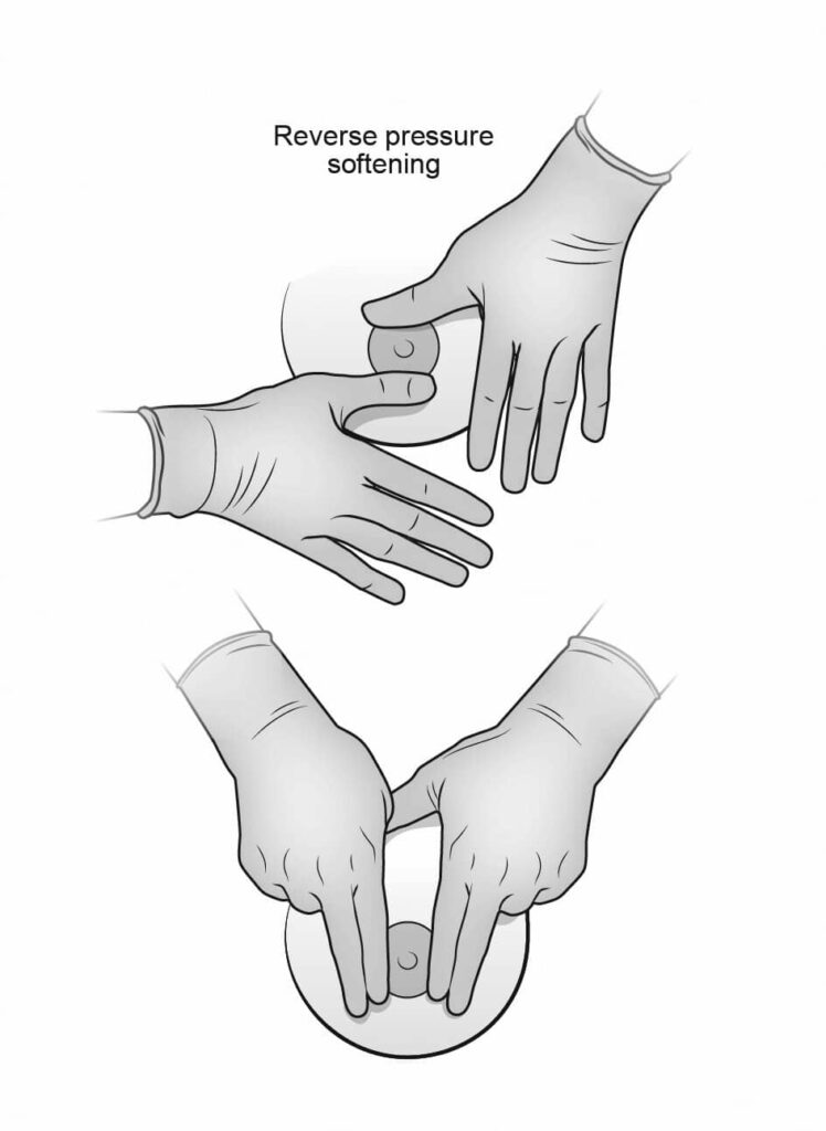 Reverse pressure softening technique.