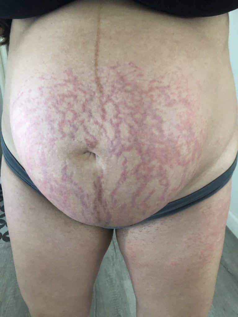 Presentation of PUPPP on stomach