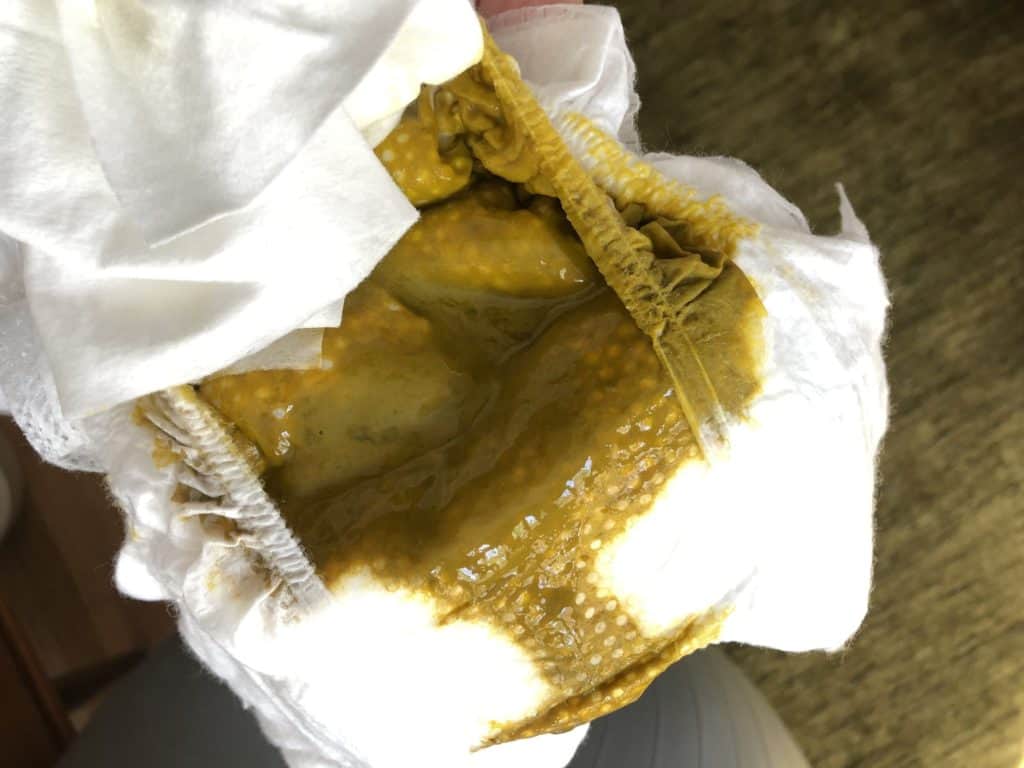 Diaper of infant prior to treating mom for hyperlactation.