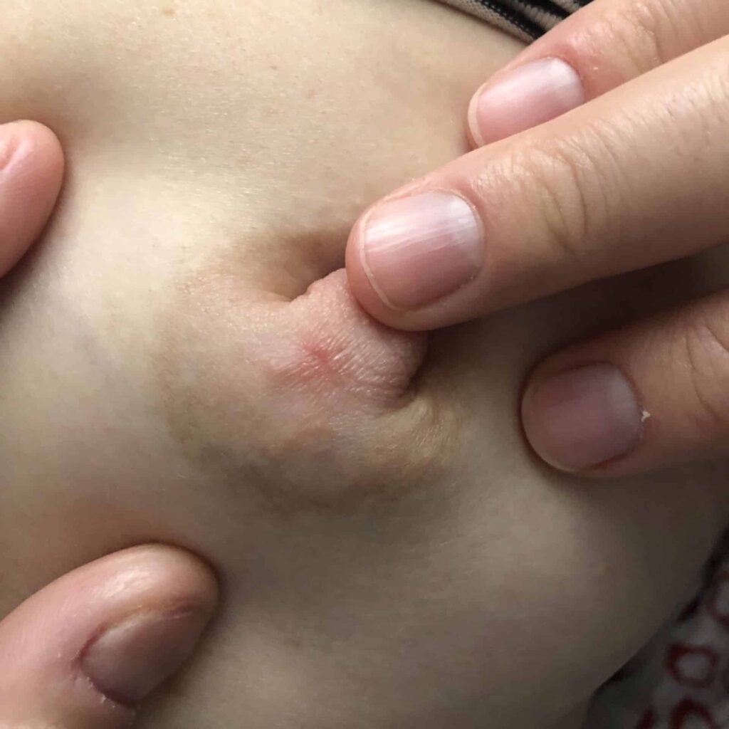 Clamping with hyperlactation prior to the eruption of teeth.