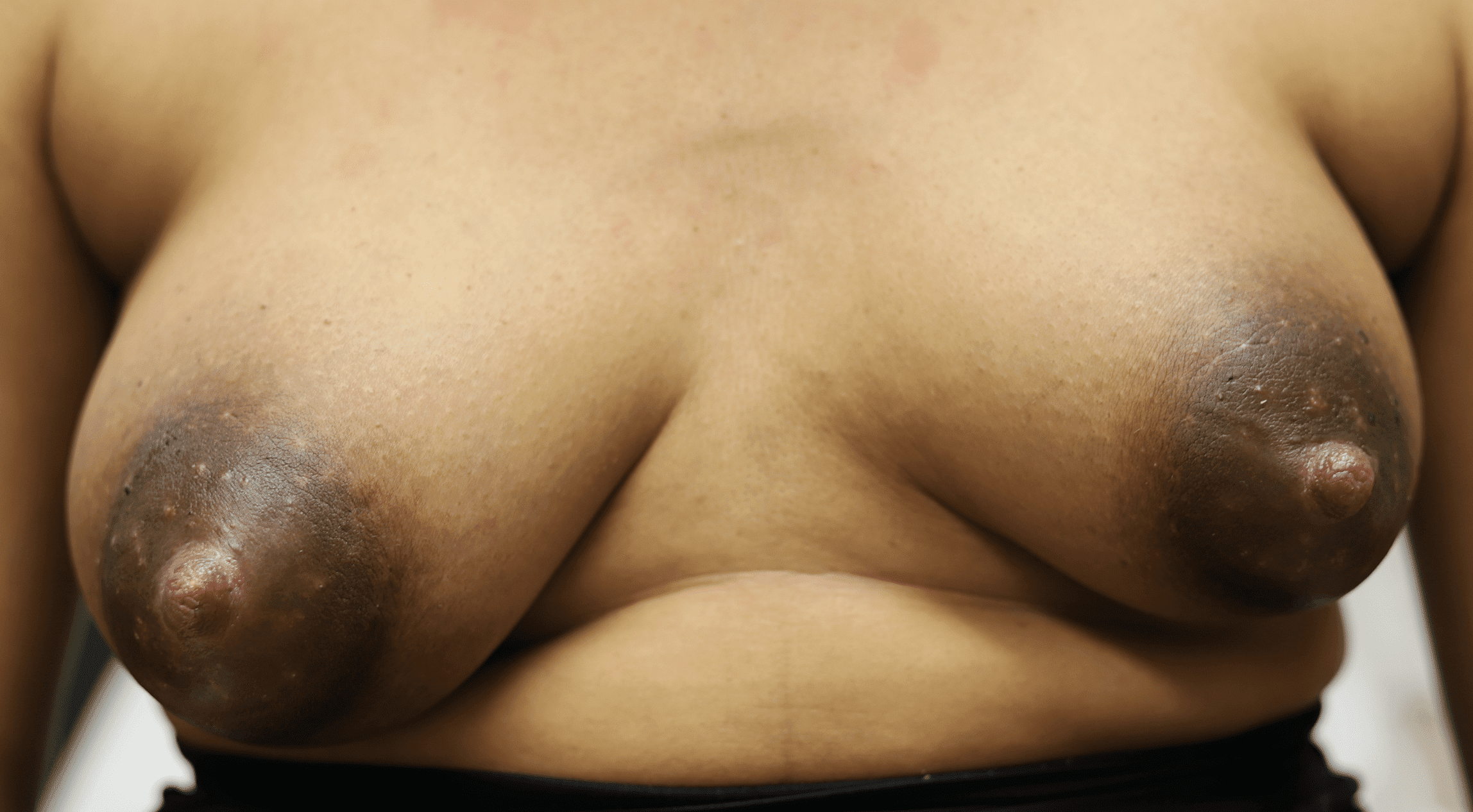 Mild tubular breast as evidenced by asymmetry,