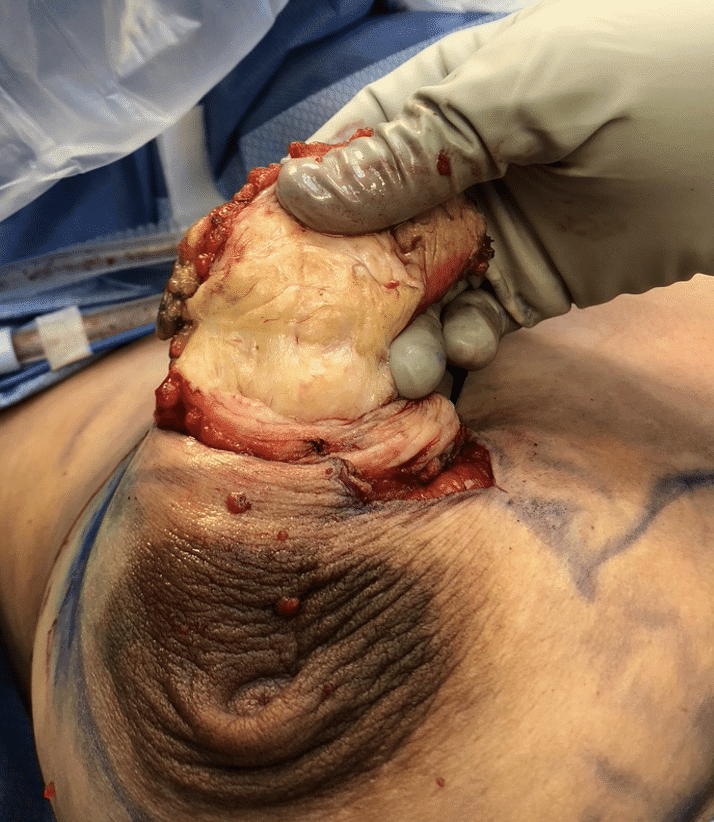 Breast tissue of postpartum mom during surgery. DO NOT MASSAGE THIS TISSUE! Dense breast tissue is similar in texture to very tough, chewy calamari. Ducts are microscopic. Massaging this gland just makes swelling worse, and causes tissue damage.