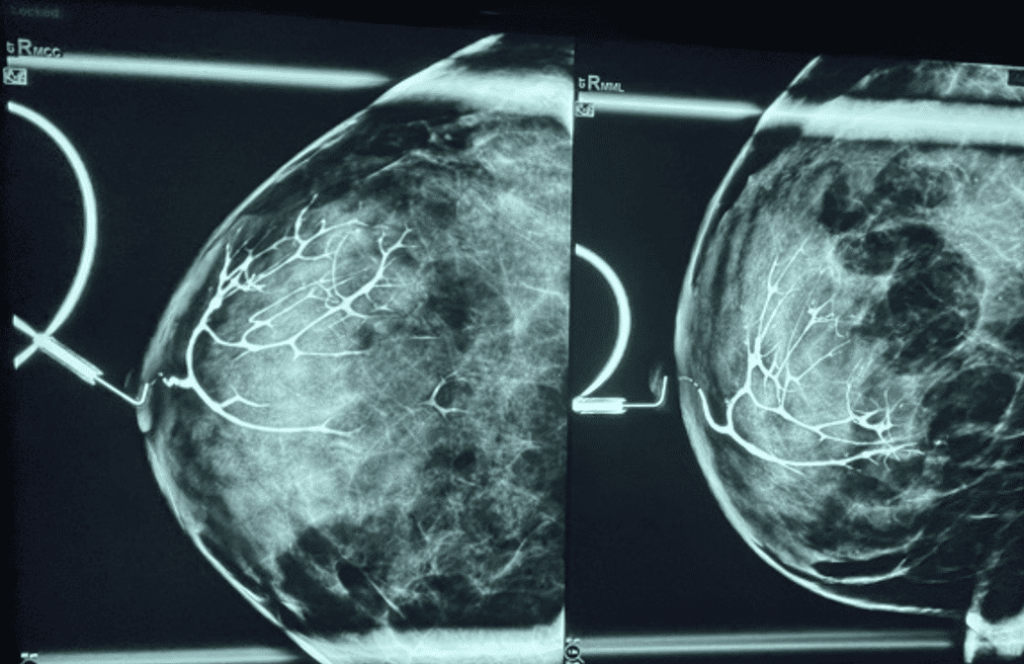 Ductogram of the breast demonstrating innumerable interlacing small ducts and ductules.