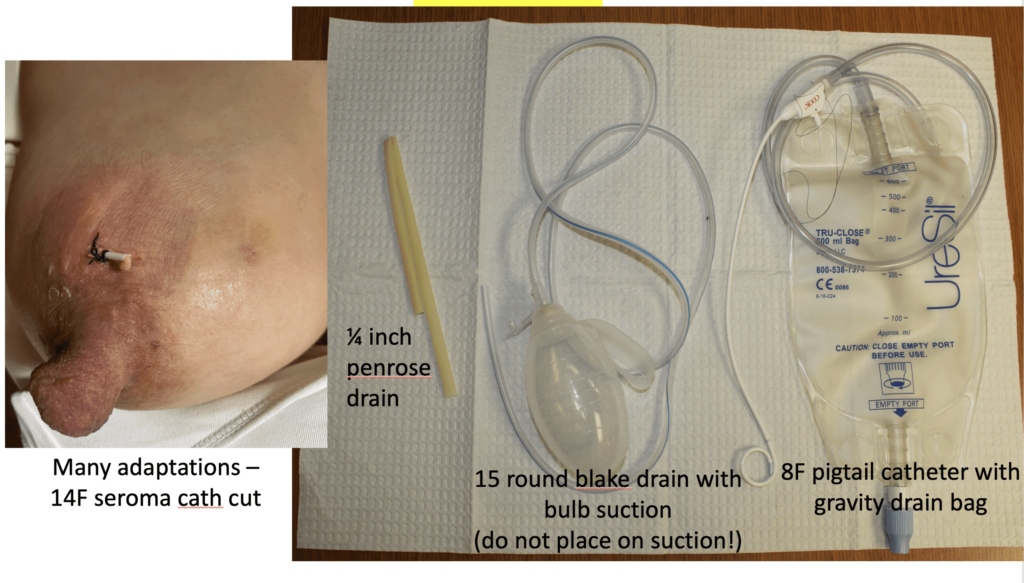 A penrose drain acts as a wick/stent to keep the skin open and allow underlying tissue to decompress. Other options that act as a wick/stent are the seromacath, Blake drain, and pigtail catheter. Vacuum assisted devices should NEVER be used on a lactating breast. Drains should not be placed to suction.