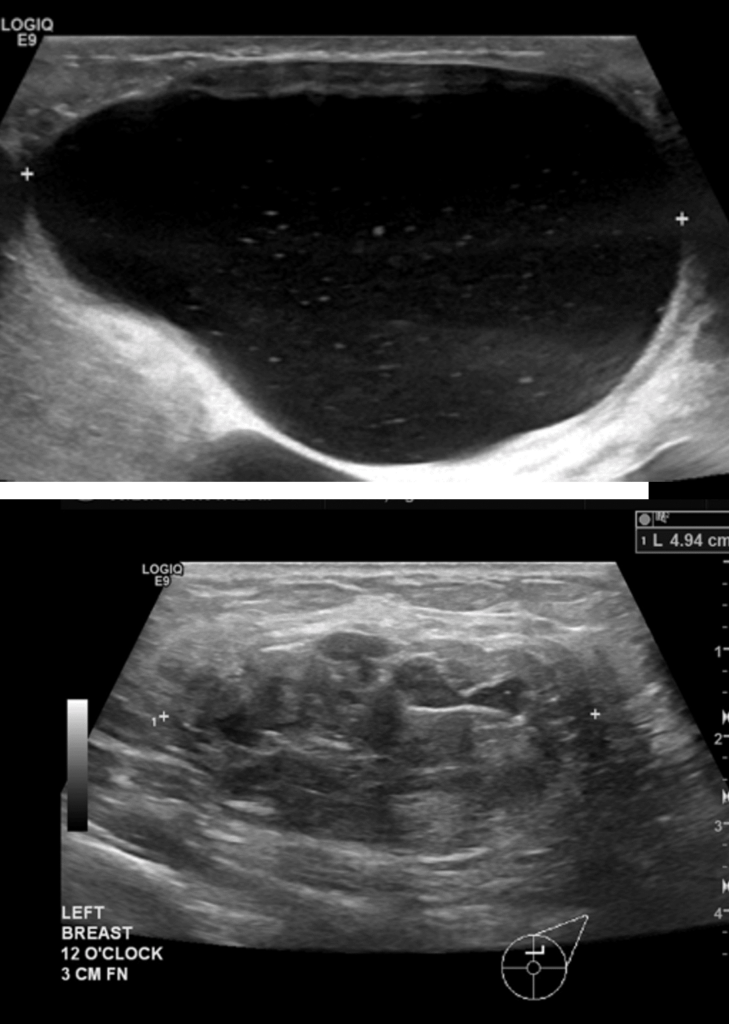 Top image demonstrates classic simple galactocele with fluid and milk (white spots). Bottom image shows a chronic, complex galactocele that would not be amenable to drainage with a needle alone.