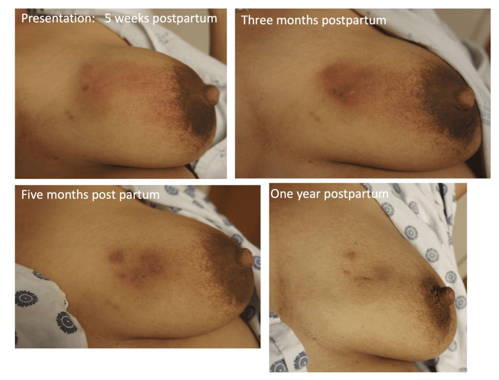 Phlegmon natural history in a patient who underwent an early drainage that yielded little fluid.