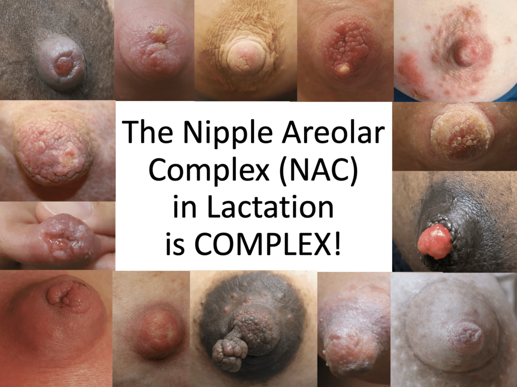 The Nipple Areolar Complex (NAC) in Lactation is COMPLEX!