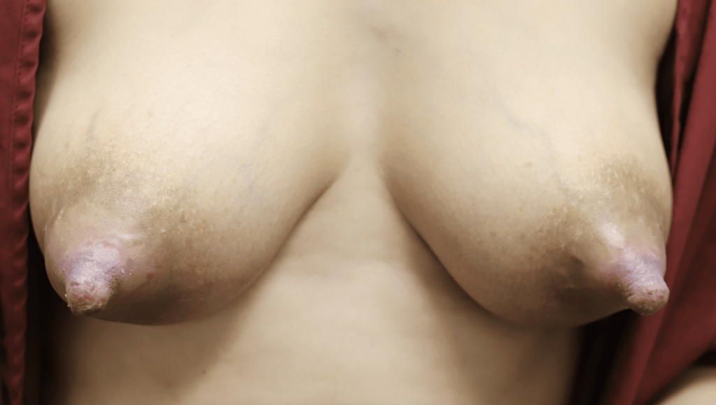 Patient with bilateral nipple trauma from coconut oil and high pump suction.