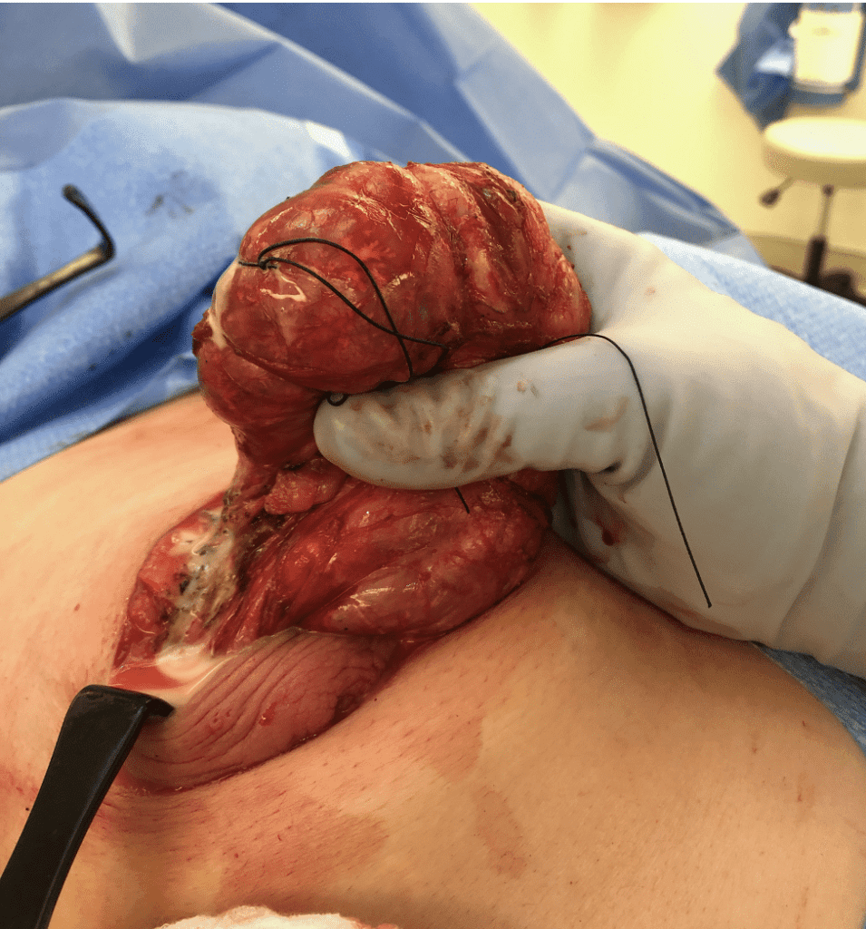 Excision of hamartoma at one year postpartum during lactation.