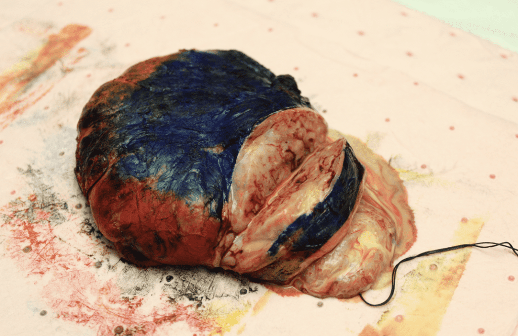 Milk was found throughout hamartoma lesion in pathology lab.