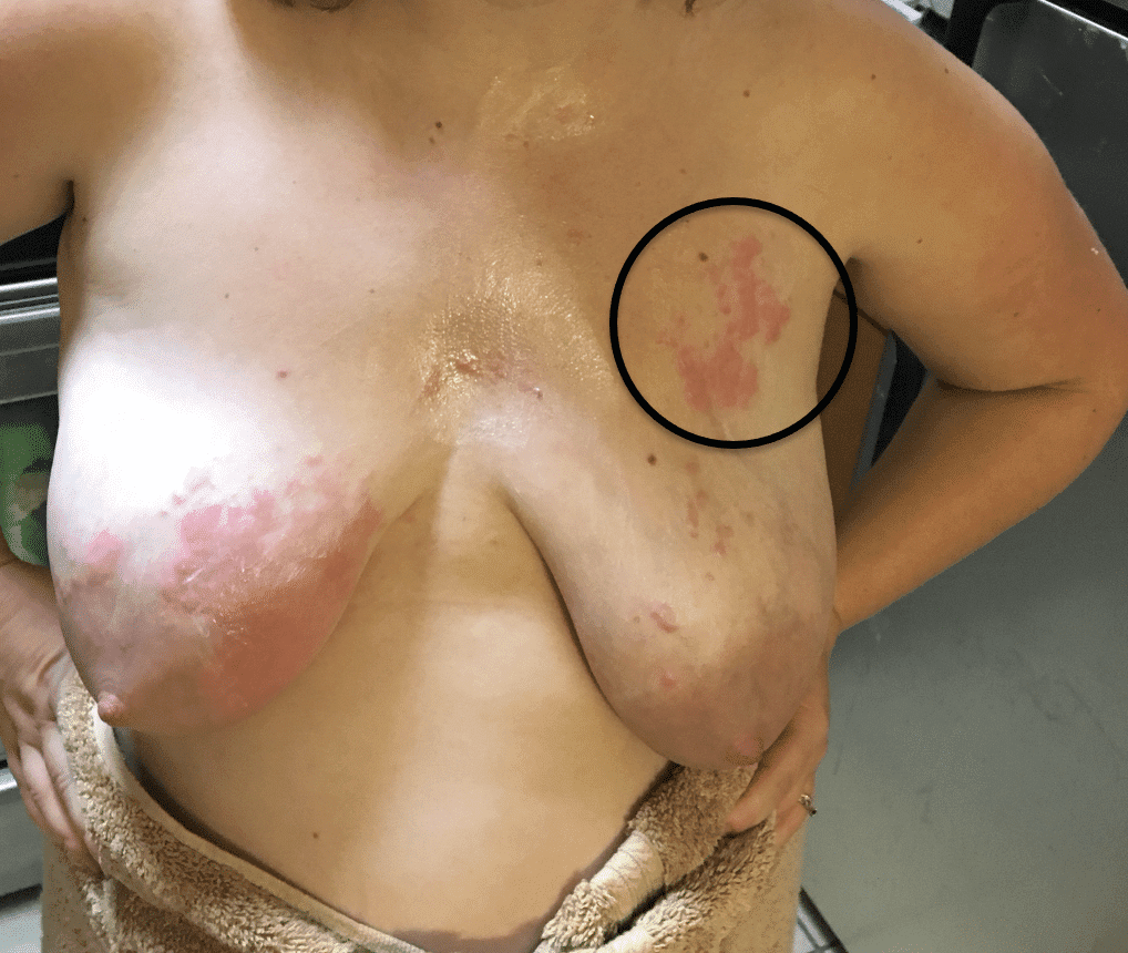 Mother treated with anti-fungals before presenting for evaluation to physician. Circle outlines where her toddler was touching her with his hand after climbing in a tree that she was allergic to.
