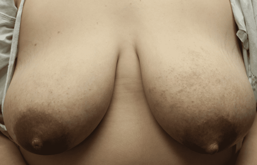 Nursing Pad Dermatitis