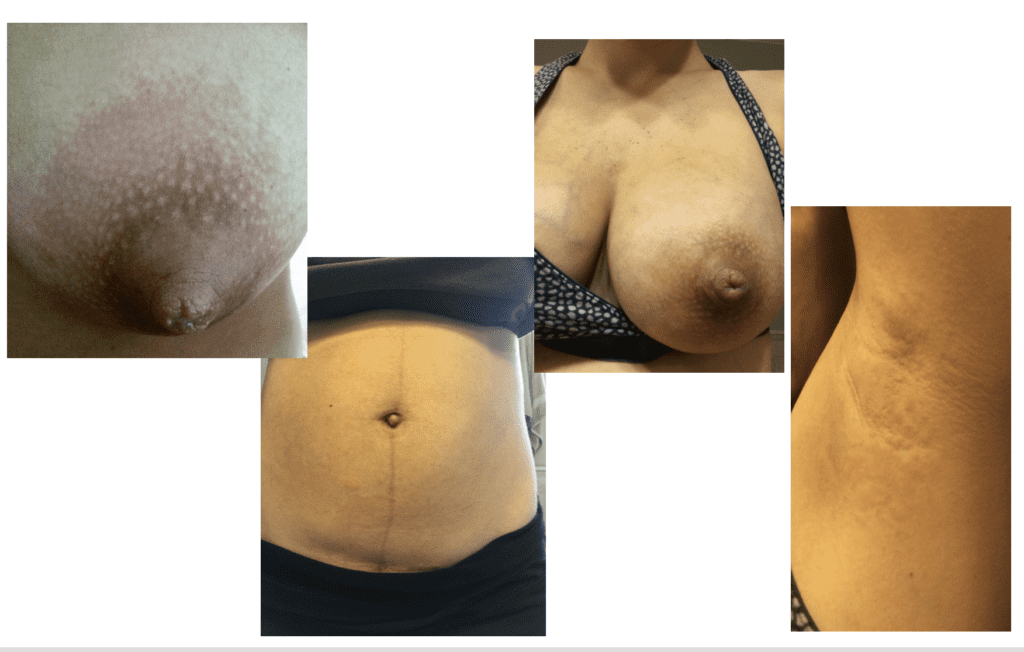 PUPPP and hives all over body