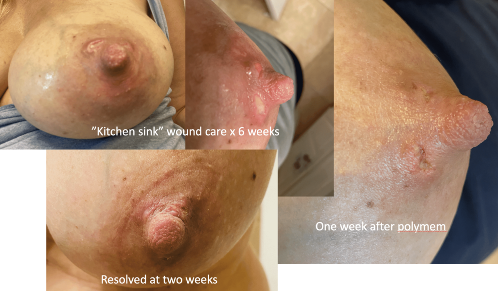 polymen, kitchen sink wound care