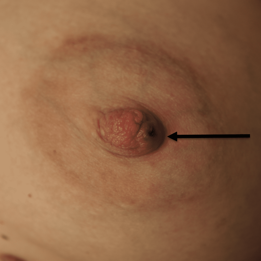 Small hematoma (blood blister) at site of nipple piercing but continued breastfeeding.