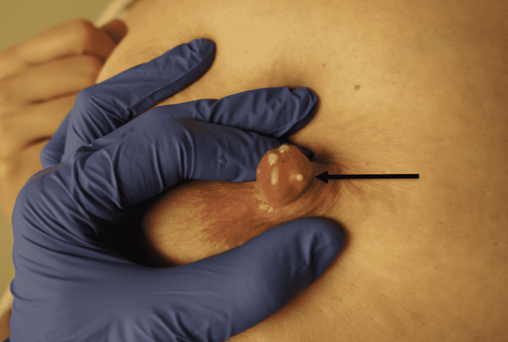 Milk may be expressible through nipple piercing sites and this is not harmful.