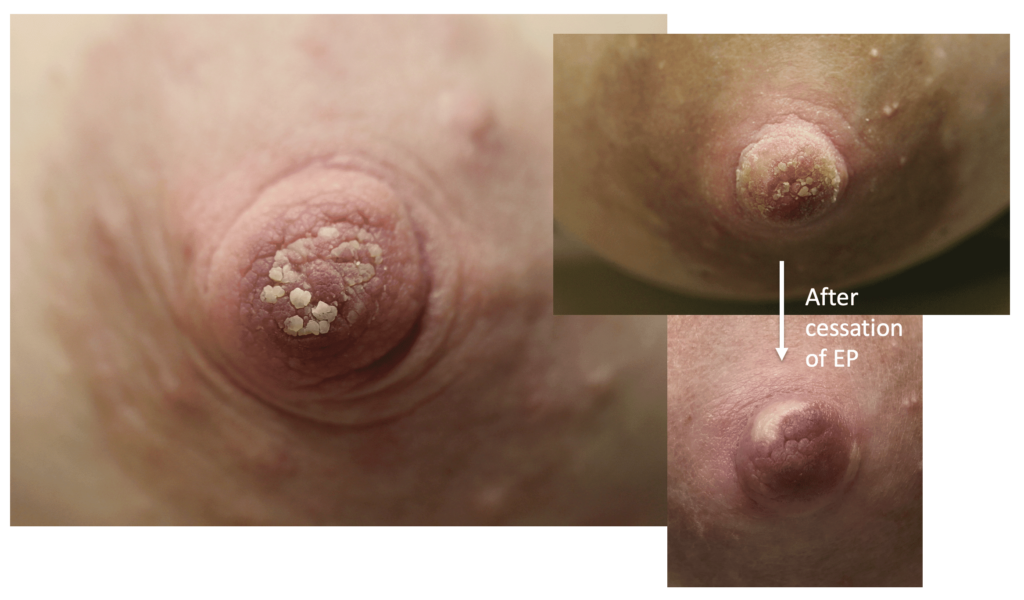Images demonstrating nipple crust. Nipple crust resolves with cessation of exclusive pumping, but the patient in the images on the right had developed a chronic scar on her nipple surface from excessive cleaning.