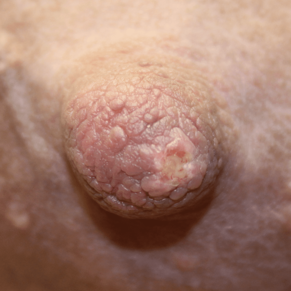 Nipple ulceration from Gentian Violet