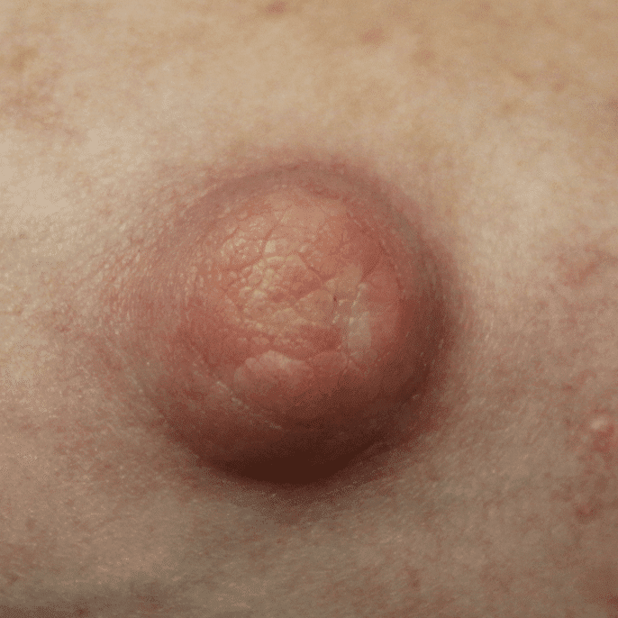 Chronic vasospasm with pumping that led to tissue breakdown on the nipple. This was resolved with heat and cessation of pumping.