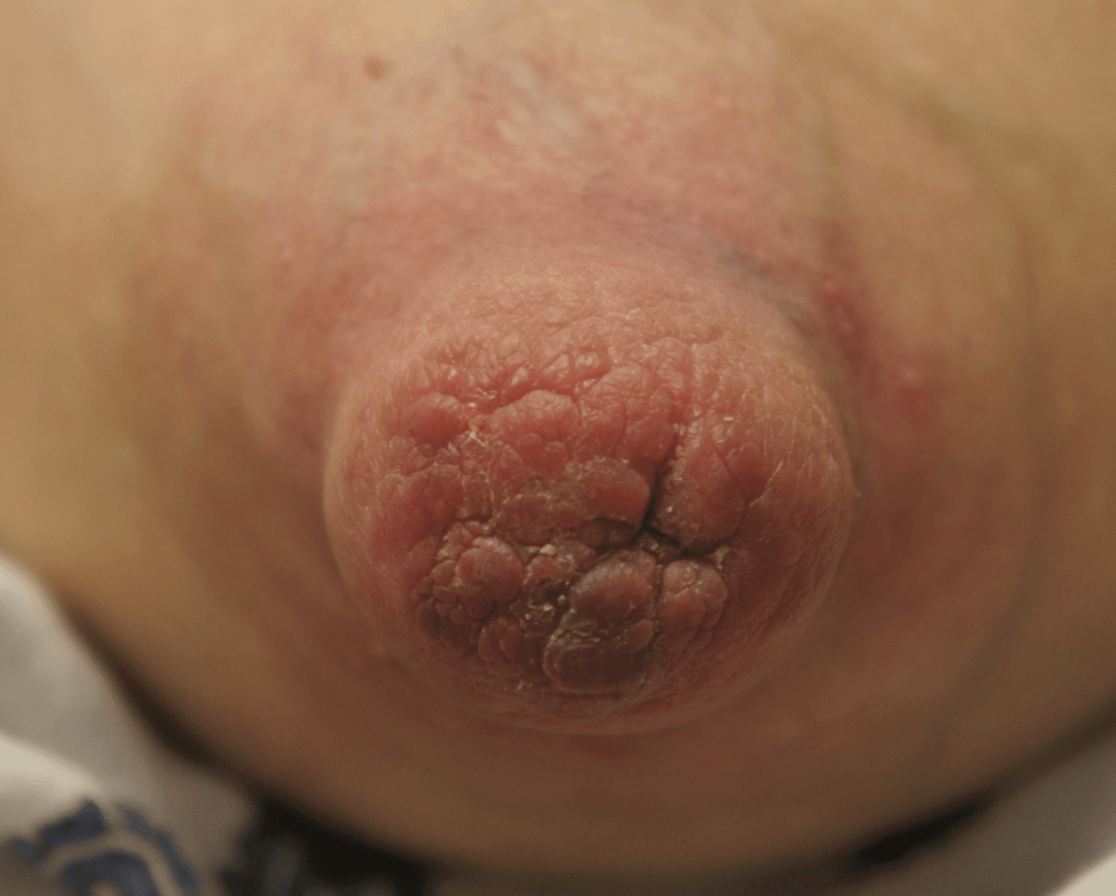 Very large nipples necessitate exclusive pumping until baby is larger and able to latch to deeper breast tissue.