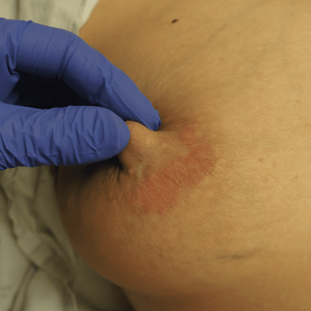 Patient with allergy to bananas her child was eating. Dermatitis involves the areola and rarely impacts the nipple (normal skin island between dermatitis and normal nipple in this photo). Paget’s disease starts on the nipple and moves outward.