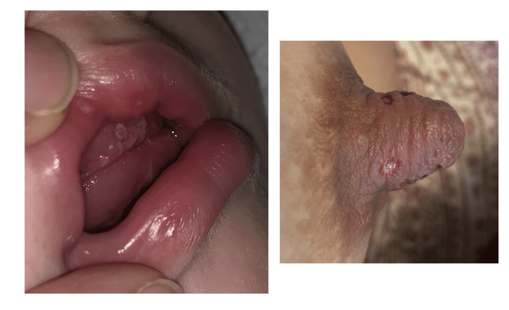 Infant with herpes vesicles on lips and gums and mom with lesions on nipple.
