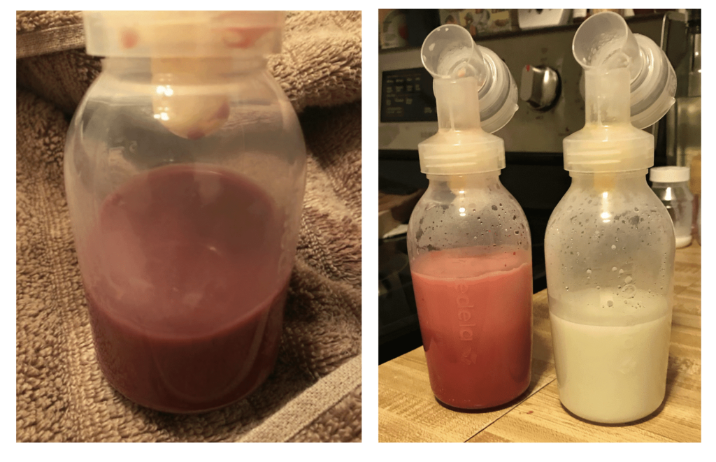 Breastmilk tinged with blood in the setting of early lactation (left) and hyperlactation (right).