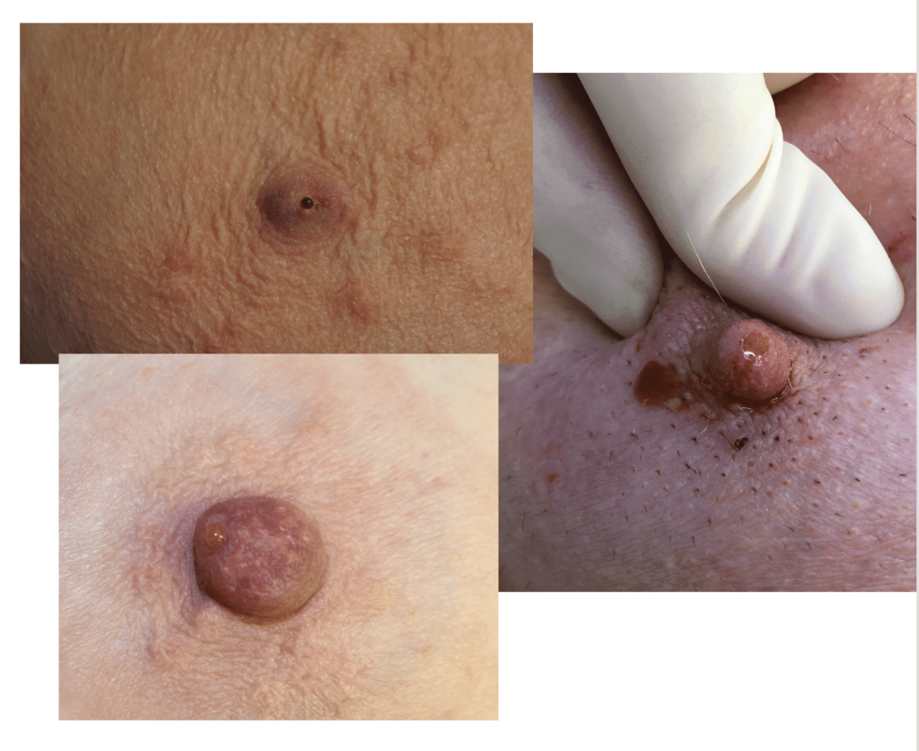 Pathologic discharge that is clear and bloody, and appears without stimulation from one orifice.