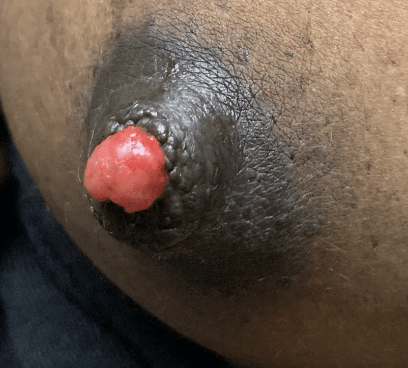 Syringomatous adenoma, which is more prone to growth and tissue destruction, required removal in the postpartum time period and precluded breastfeeding on this breast prior to that.