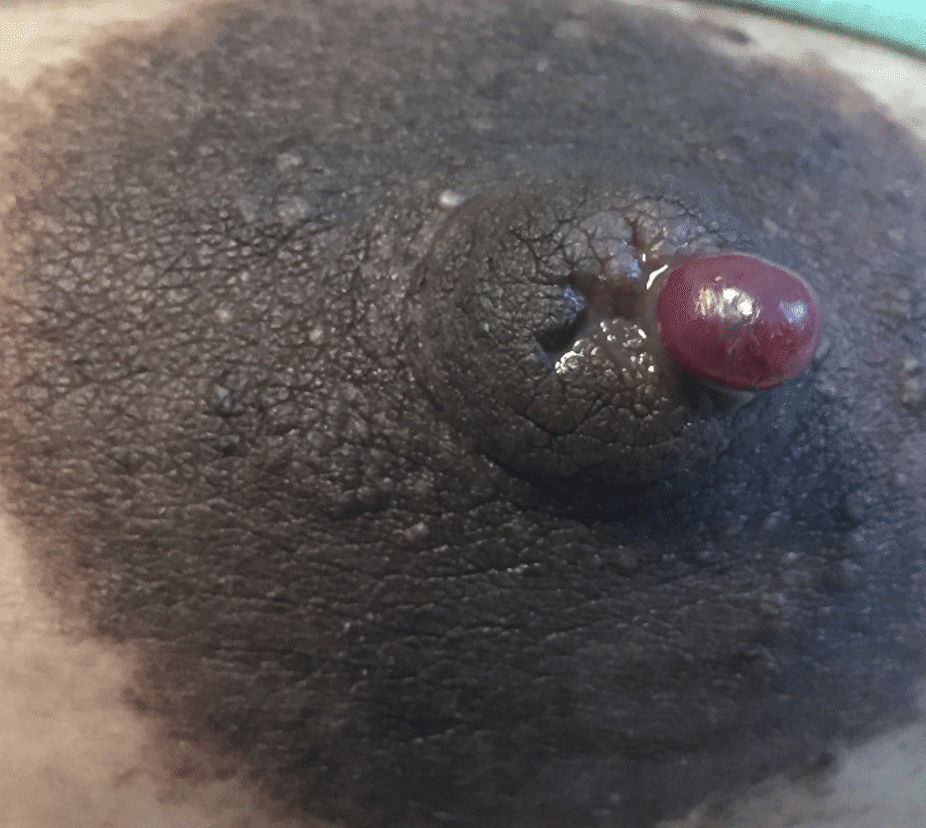 Syringomatous adenoma, which is more prone to growth and tissue destruction, required removal in the postpartum time period and precluded breastfeeding on this breast prior to that.