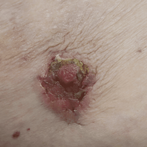 Chronic Pagetoid changes with destruction of nipple.