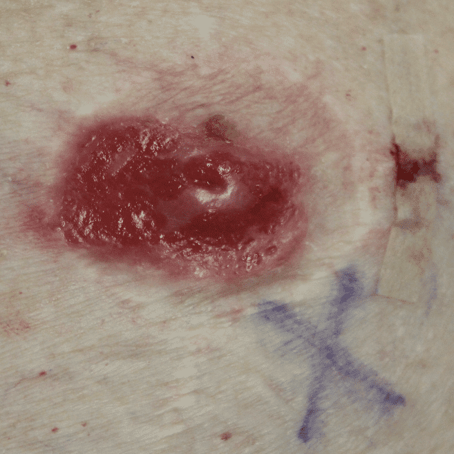 Chronic Pagetoid changes with destruction of nipple.