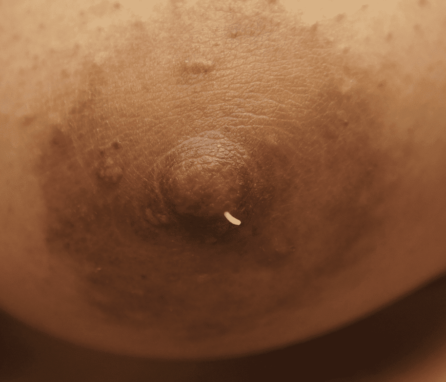 Sebum emanating from nipple sebaceous cyst.
