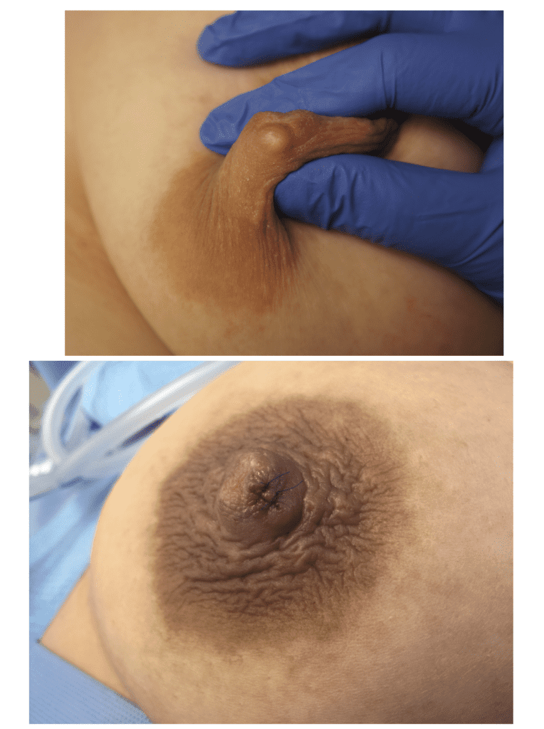 Large sebaceous cyst that was repeatedly problematic for patient excised under local anesthesia during pregnancy. Incision was closed with two interrupted 6.0 prolene stitches taking care to avoid surface nipple orifices, and removed 5 days later. She breastfed without difficulty postpartum.