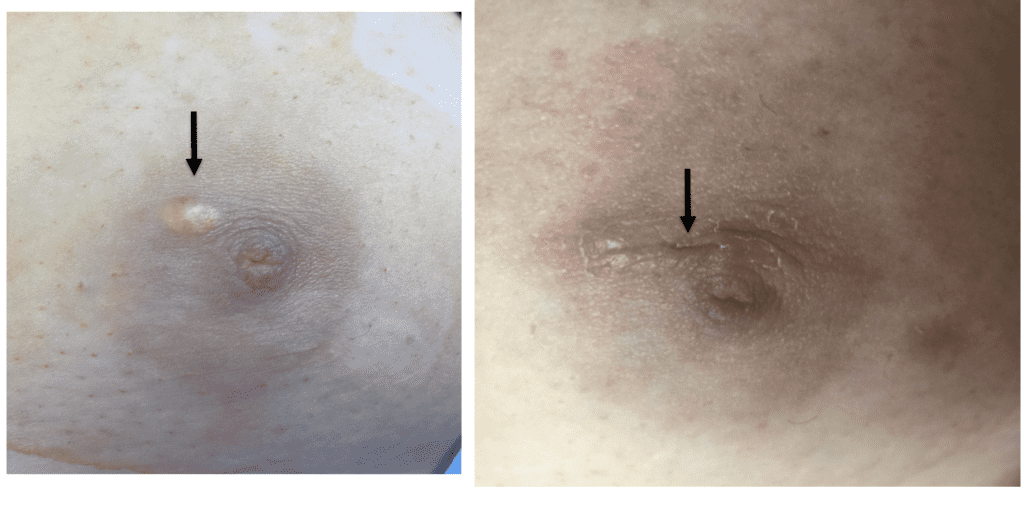 Simple cyst on areola excised pre-pregnancy to reduce potential for postpartum trauma during lactation.