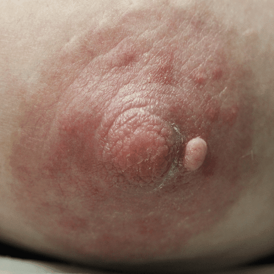Smaller papilloma of areola.