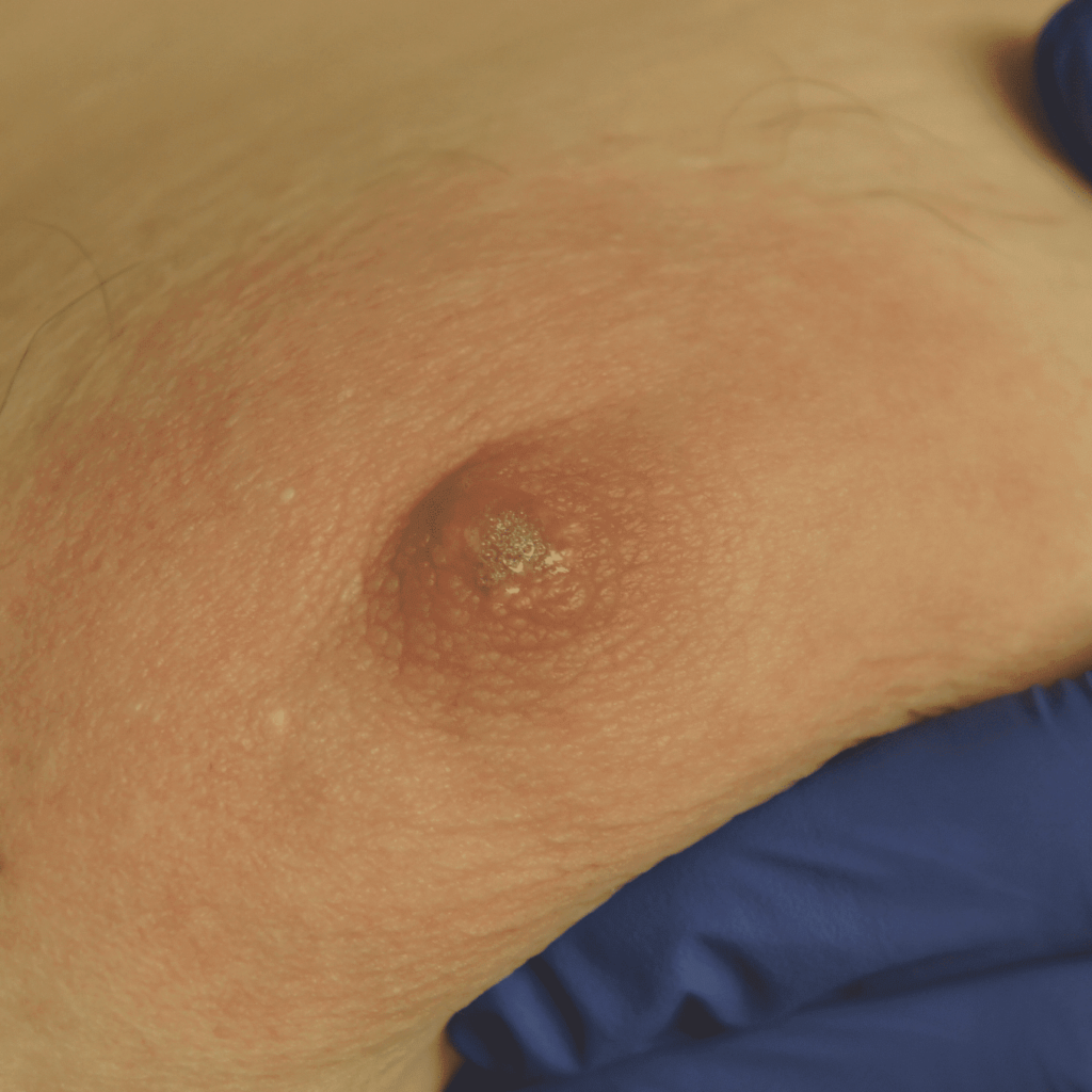Small skin tag removed with dermabond (skin glue) closure.