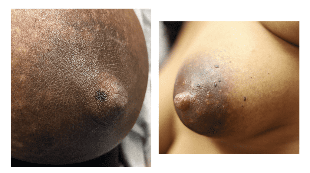 Left photo shows solitary (single) nevus and right photo shows multiple seborrheic keratoses.