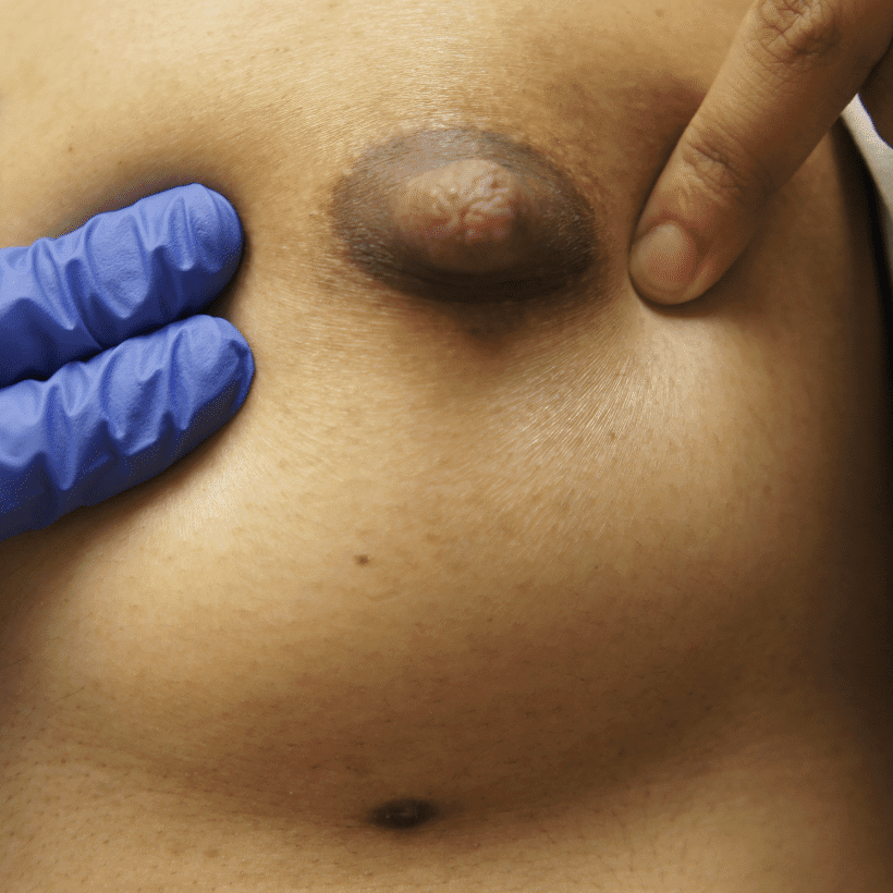 small supernumerary nipple