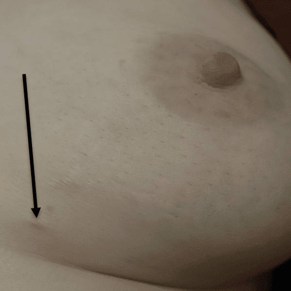 Very faint, small supernumerary nipple and areola in a fair-skinned patient. She was referred for evaluation of potential milk fistula, when in fact this was a normal nipple producing small amounts of milk with stimulation.