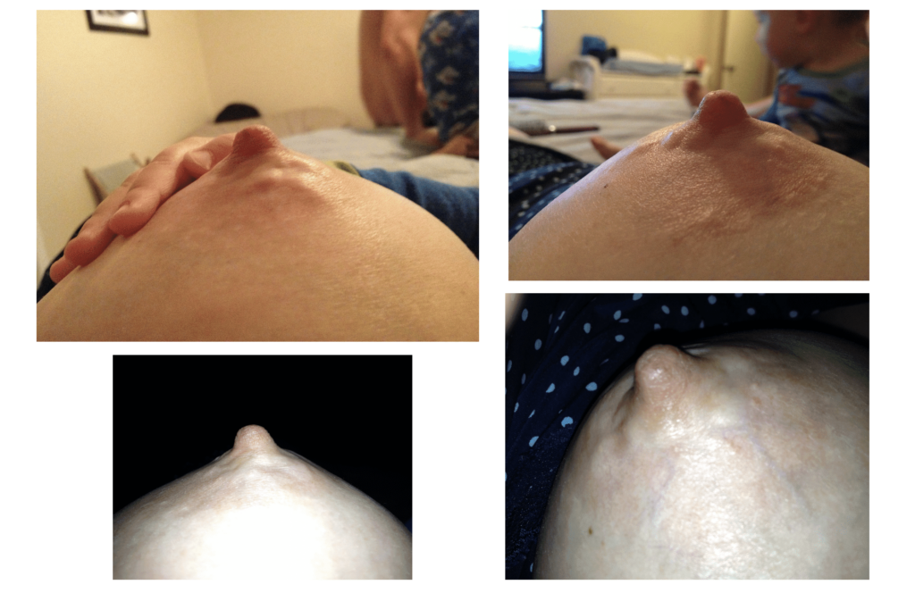 Palpable and dilated ductal tissue present just behind the surface of the areola skin in a thin patient.