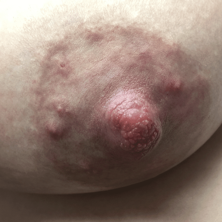 Normal Montgomery Glands.