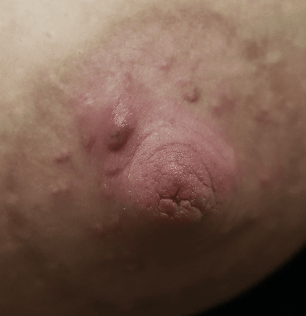 Obstructed Montgomery Gland from coconut pump flange lubrication.