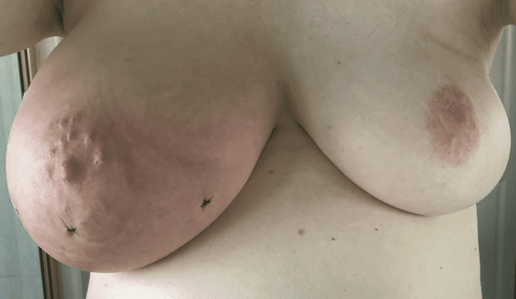 As pregnancy progressed, her right breast continued to enlarge and she underwent imaging and biopsies showing edema (tissue swelling) but no cancer.