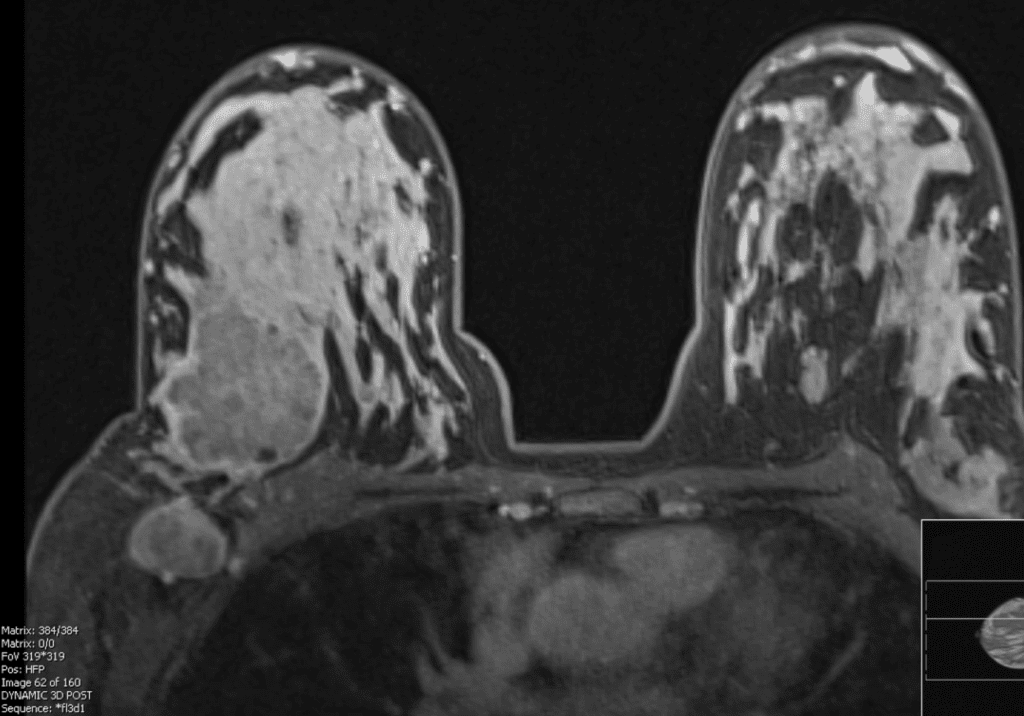 Patient two weeks postpartum with right breast cancer and abnormal lymph node visualized on MRI.
