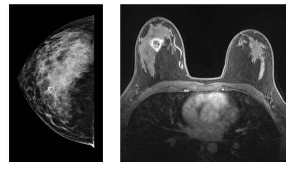Patient six months postpartum with new lump right breast that was not well visualized on mammogram but appeared distinctly on MRI.