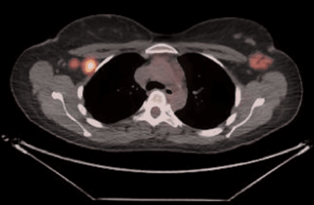 Staging PET CT showing a right breast tumor, right lymph node involved with cancer, and a left breast area of “avidity” during lactation. This left breast area was biopsied and showed lactational changes only.