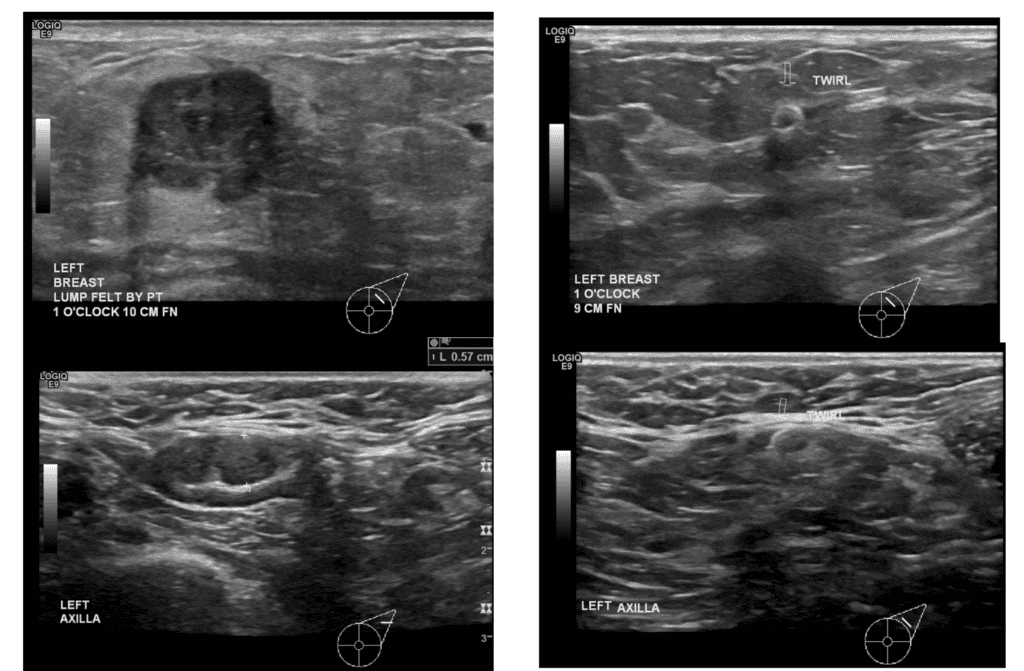 Ultrasound images showing abnormal mass (upper left) and abnormal lymph node (lower left) at patient presentation. After chemotherapy, there was no mass visible in the breast (upper right) and the lymph node had normalized in appearance (lower right).