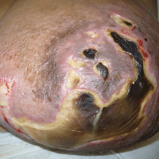 Progression to skin ulceration and death postpartum.