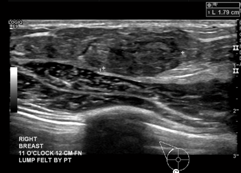 Xray of Right Breast after a lump was felt by the patient